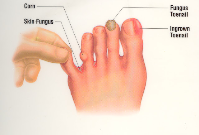 SKIN DISORDERS Ingrown Nails skin-disorders-ingrown-nails
