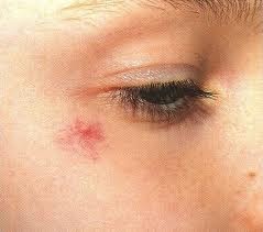 Dermatite Atopica Terapia Macchie Rosse Sul Viso Bruciore Dermatite Atopica Terapia Macchie Rosse Sul Viso Bruciore