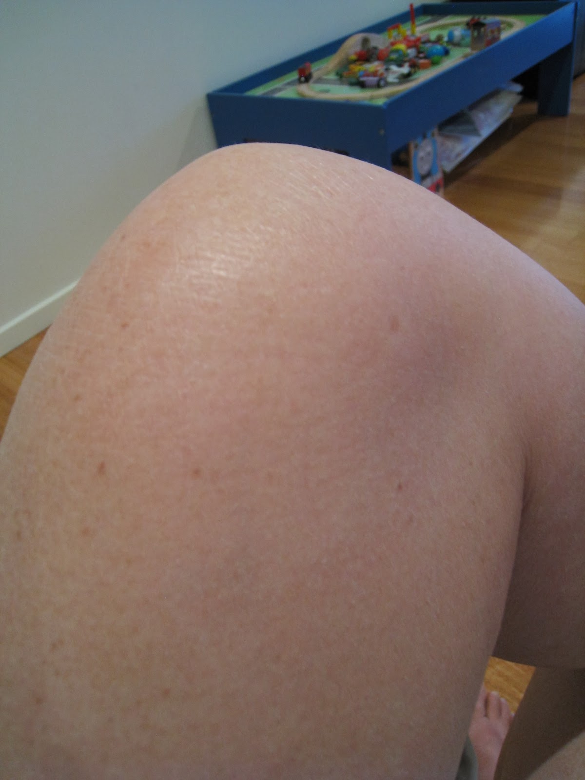 Topical Steroid Withdrawal JourneyHealing Eczema and Red