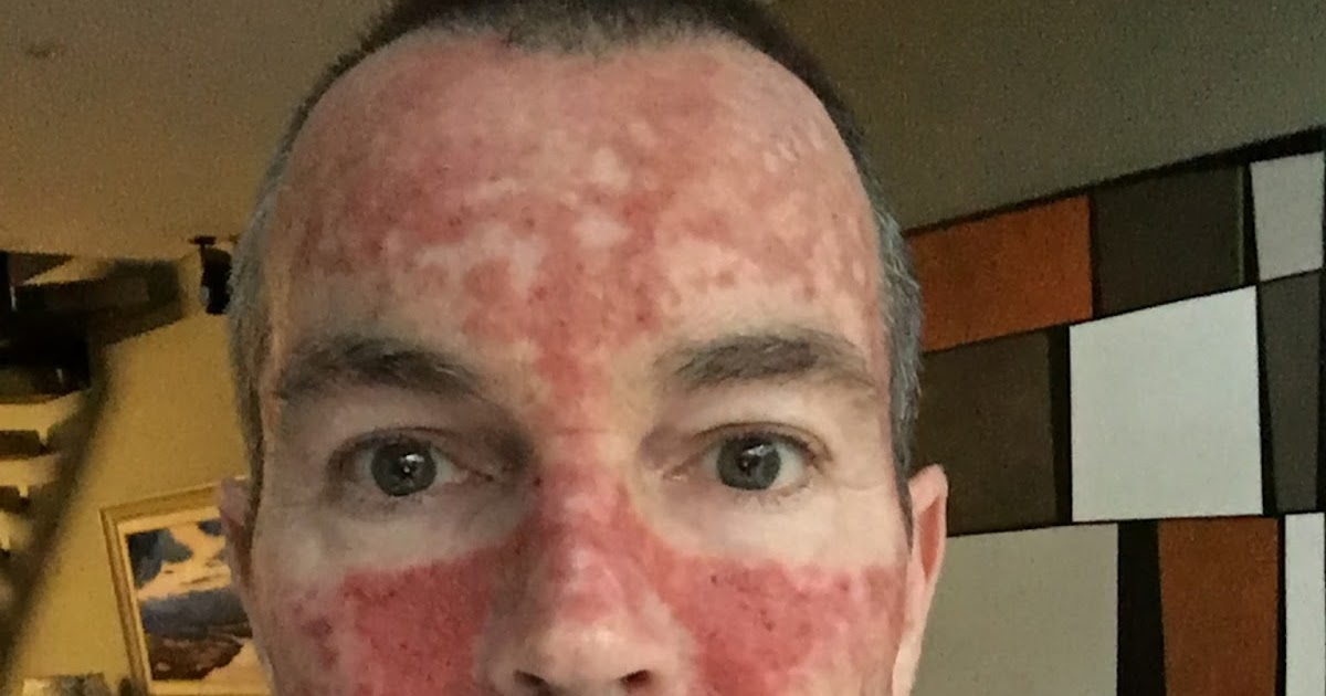 Efudix Treatment: Day 21 - Post day 3