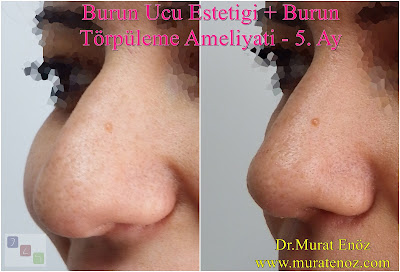 nose tip surgery, nose operation, nose tip reshaping, tip rhinoplasty, tip plasty, nose tip reduction, nose, tip refinement, tip rhinoplasty cost, nasal tip surgery, nasal tip refinement, nose tip surgery before and after, lift nose tip naturally, nose tip lift, nose tip reshaping cost, nose tip reshaping without surgery, bulbous, nose tip reshaping, nose tip reshaping before and after, reshaping nose tip, nasal tip reshaping, cost of nose tip reshaping, nose tip surgery, nasal tip surgery, nose tip surgery before and after, nose surgery, tip of the nose surgery, tip nose surgery, plastic surgery nose tip, bulbous nose tip surgery, nose, tip plastic surgery, nose surgery tip only, plastic surgery tip of nose, tip nose surgery before and after, tip surgery nose, nasal tip surgery before after, round nose tip surgery, surgery for bulbous nose tip, rhinoplasty tip surgery, bulbous tip surgery, nose surgery recovery tips, droopy nose tip surgery, nose tip surgery recovery, nose bridge reduction, nasal hump removal, nasal hump reduction, revision tip plasty