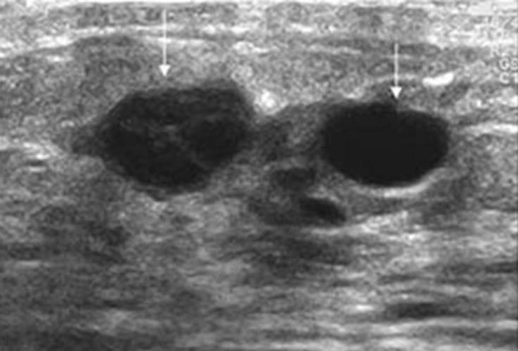 Ultrasound Of Pediatric Breast Masses What To Do With