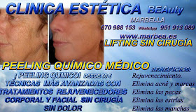 MARBELLA PEELING FACIAL QUIMICO MARBELLA PEELING FACIAL QUIMICO MEDICO PARA ELIMINACIÓN , QUITAR , TRATAMIENTO: ACNÉ , MARCAS , CICATRICES , MANCHAS ,PECAS , ESTRÍAS , MANCHAS