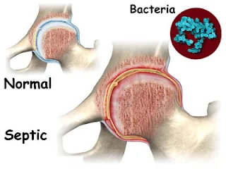Septic-arthritis