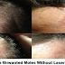 No Surgery Needed To Get Rid Of Unwanted Moles