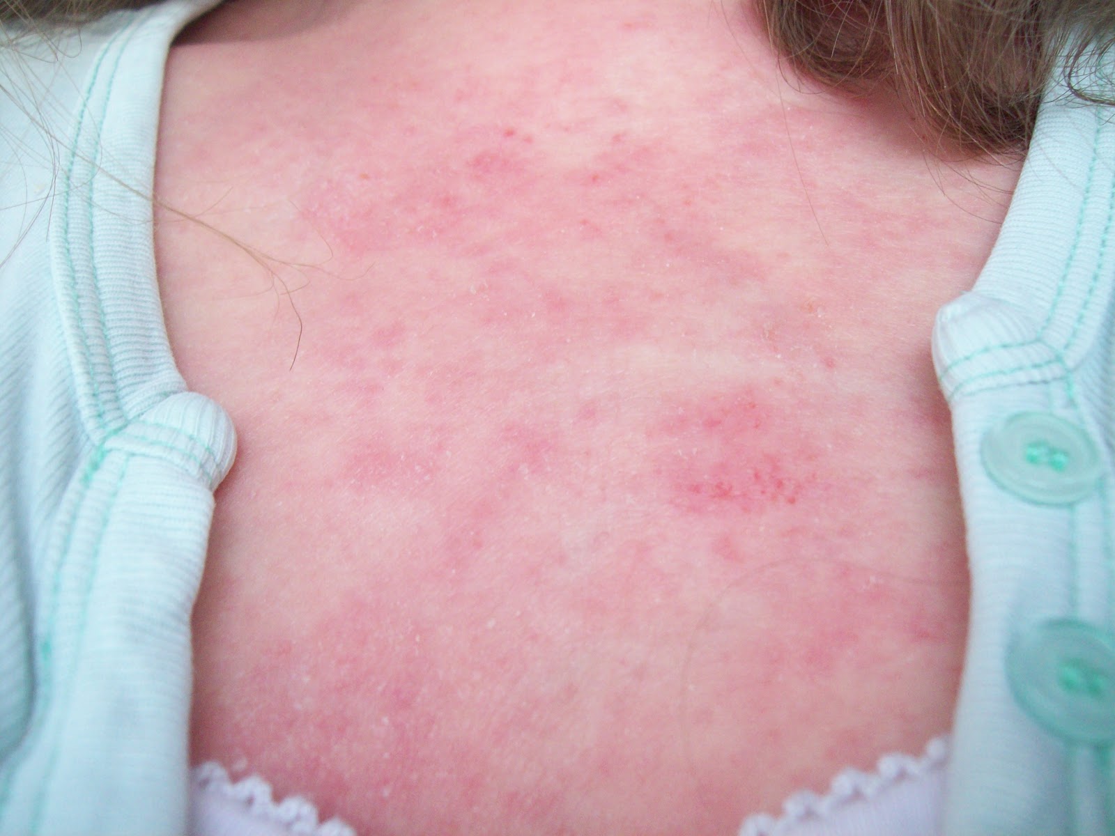 Chest symptoms and Neck rash and Red skin - Symptom ...