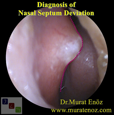 Diagnosis of Deviated Septum - Diagnosis of Deviated Nasal Septum - Diagnosis of Nasal Septum Deviation - Diagnosis of  Nasal Septal Deviation