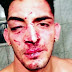 Un bailarín de Flavio Mendoza fue desfigurado en un boliche