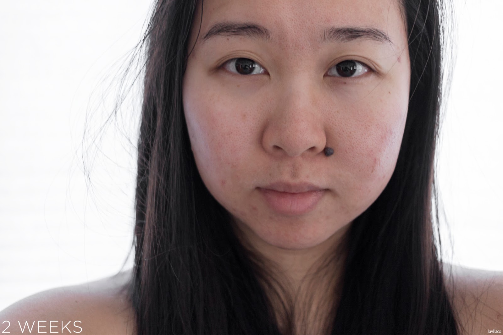 tria Hair Removal Laser Facial Hair 2 Weeks