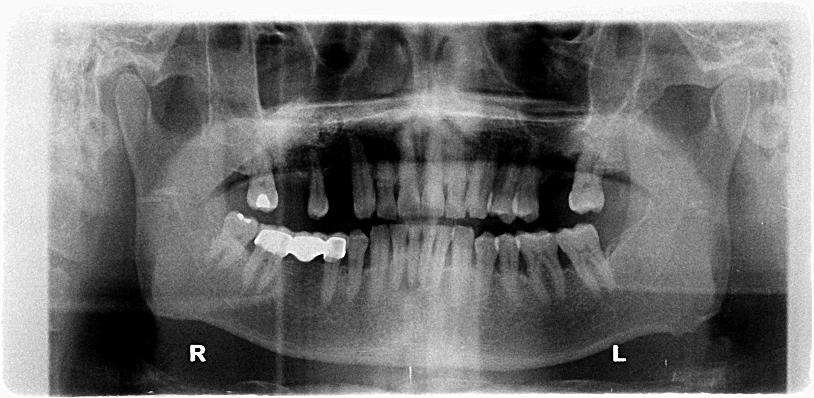 Post Lift Post Sinus Lift Complications