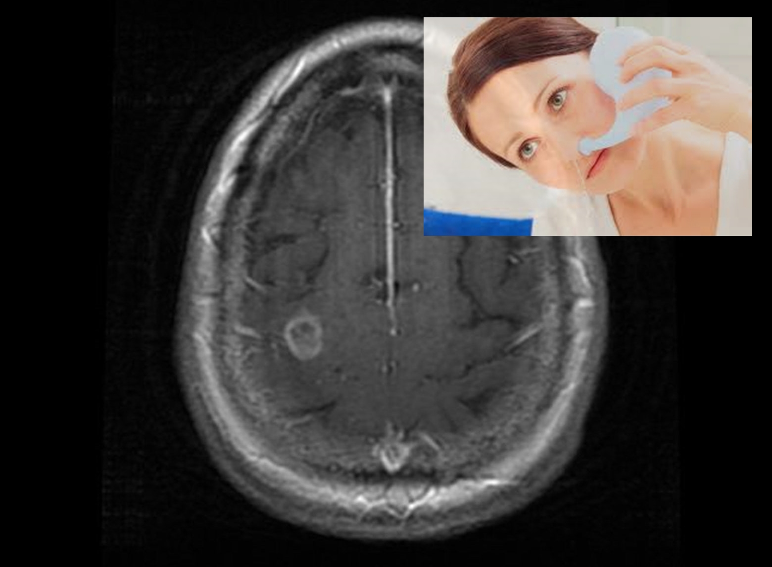 Neti Pot Ile Burun Ici Sinus Yikama Islemi Yapildiktan Sonra Ortaya Cikan Beyin Enfeksiyonu Ve Olum Vakasi Bildirildi