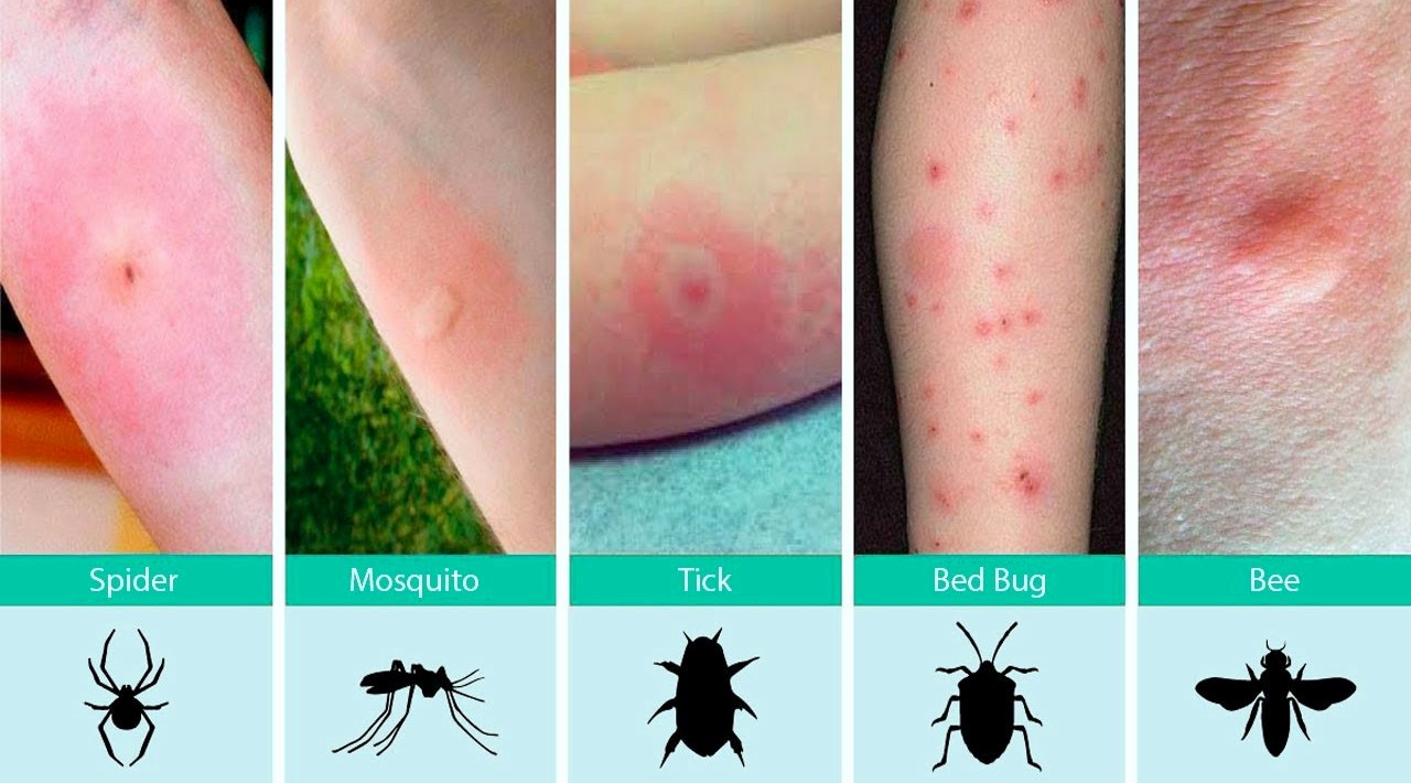 The Health Website Insect Bites And Stings