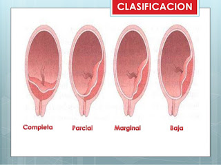 que es desprendimiento prematuro de placenta