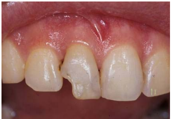 76 有一位20歲女性要求製作上顎右側正中門牙假牙 經臨床及x光檢查結果 該顆門 阿摩線上測驗