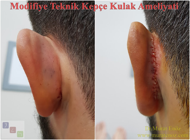 Ear plastic surgery in Istanbul - Modified technique otoplasty - Modified technique auriculoplasty - Correction of prominent ears in Istanbul  - Treatment of protruding ear - Bat ear - Obtrusive ears - Unfolded ears - Cosmetic ear surgery in Istanbul - Before and after photos for ear plastic surgery in Istanbul, Turkey - Protruding ear surgery - Conchomastoid technique for otoplasty