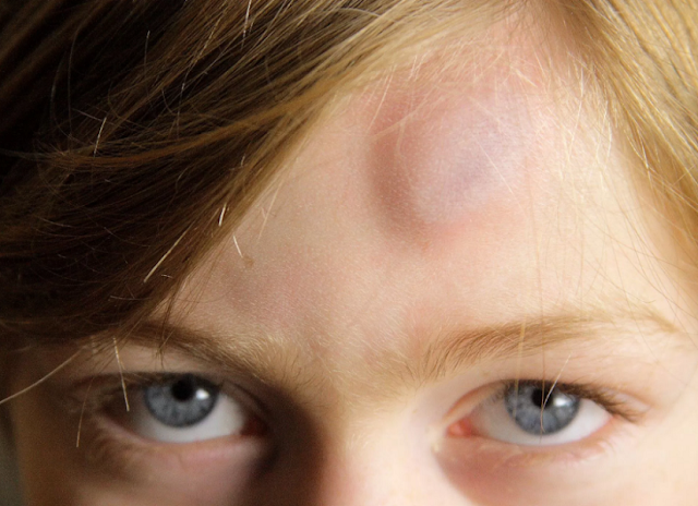 Sakit Kepala Sebelah Kiri Bisa Jadi Tumor Otak Kenali Berbagai Penyebabnya Berikut