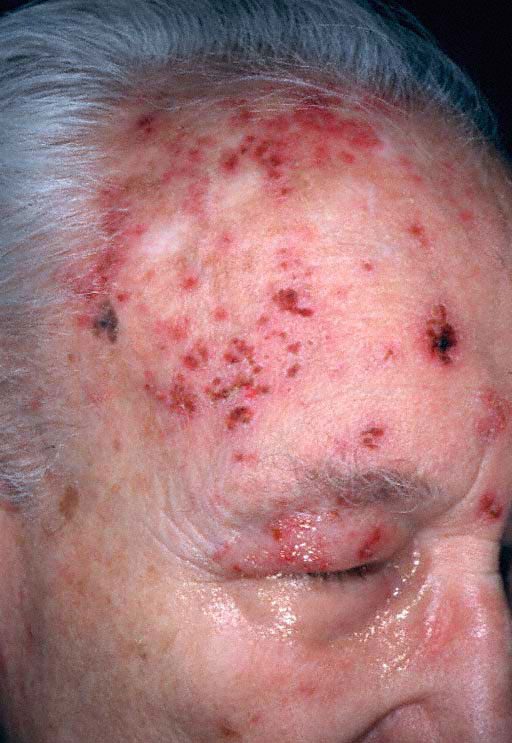 What Is A Herpes Sack - myherpestips.com