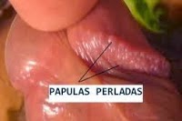 Pápulas-perladas-del-pene 