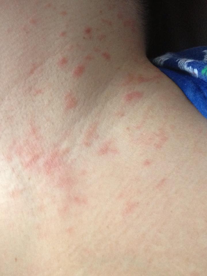 rash on neck and back