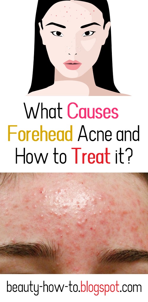 What causes forehead acne and how to Treat it? How To Beauty