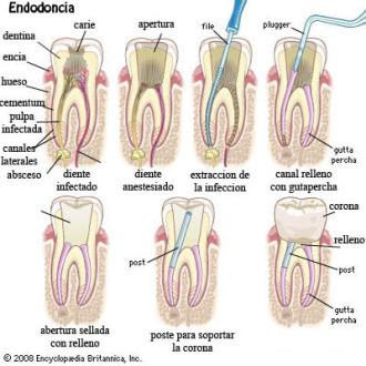 Qué causas provocan que duela un diente endodonciado