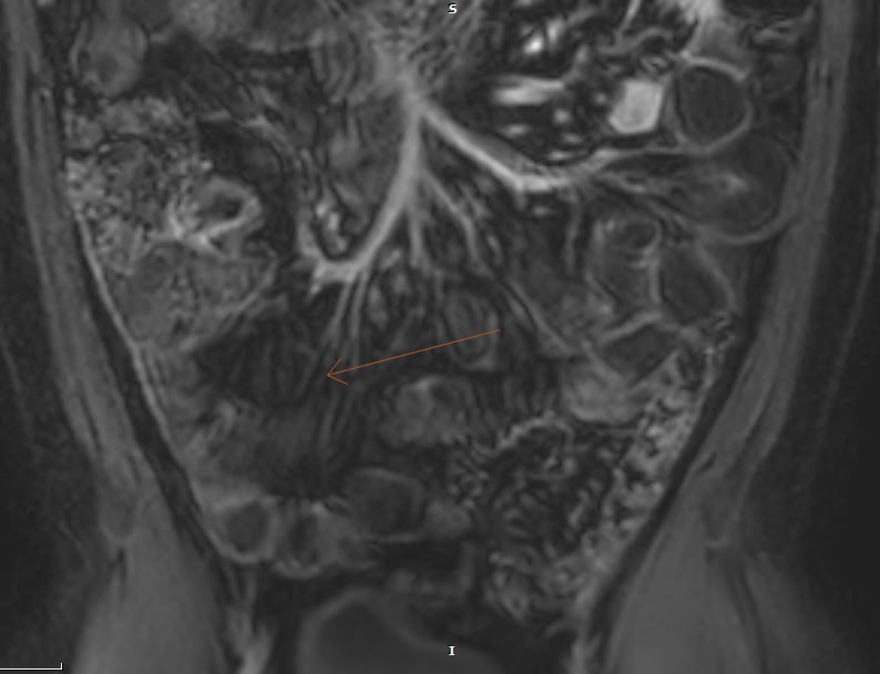 MR Enterography Crohn's Disease Sumer's Radiology Blog