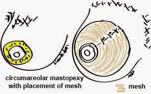 circumareolar mastopexy with mesh