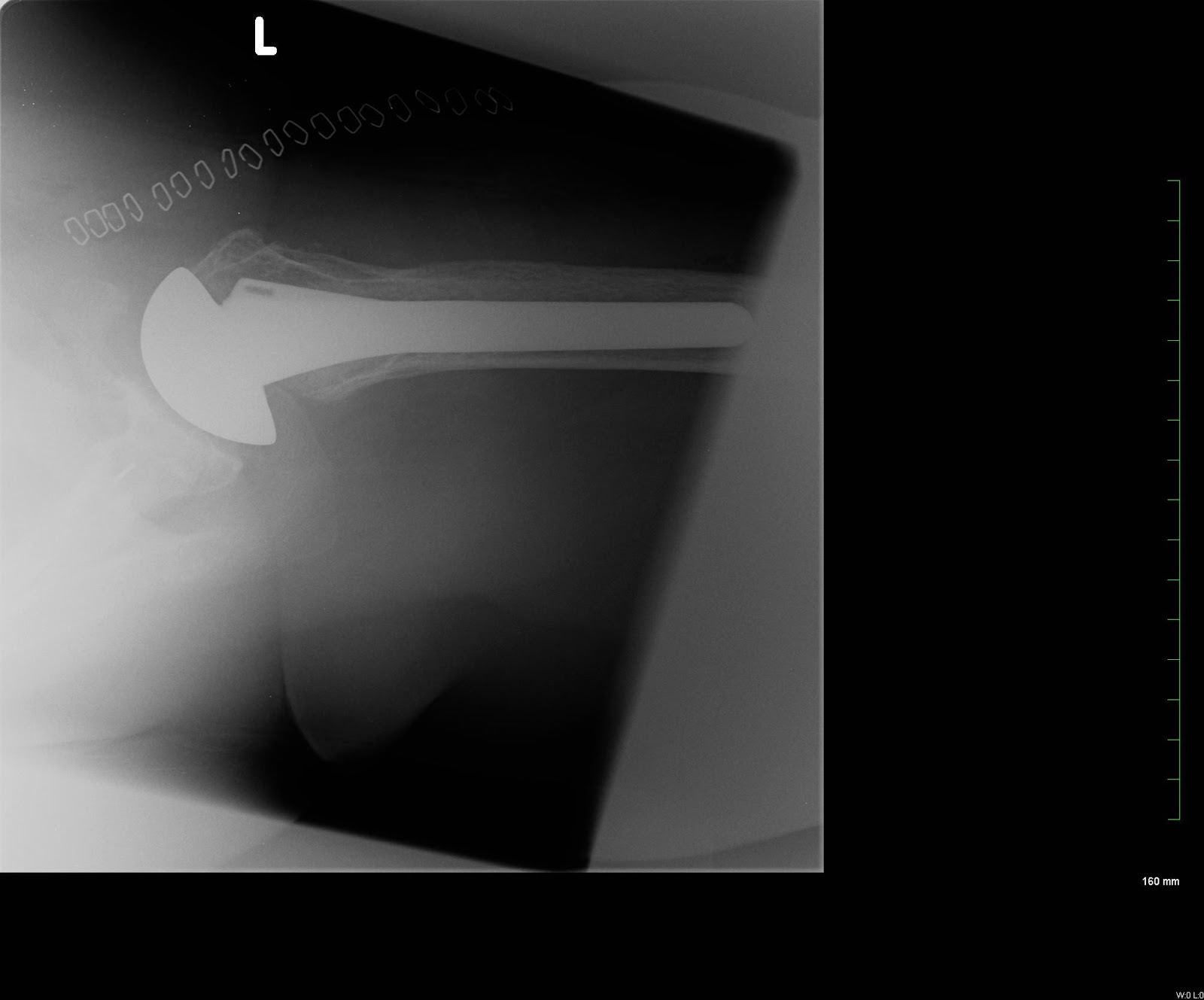 Shoulder and Elbow Surgery: Early radiolucent lines after glenoid ...
