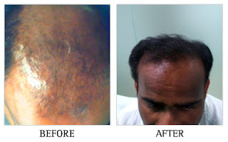  PRP for hair loss in bangalore