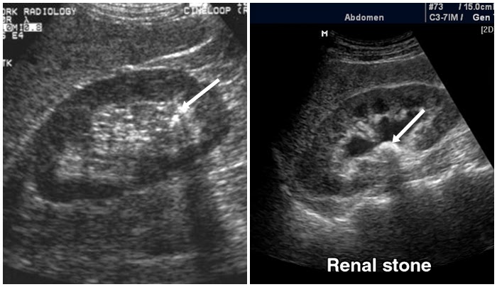 Pemeriksaan USG Ginjal