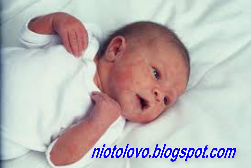 Penyakit Kulit Pada Bayi dan Anak - Niotolovo