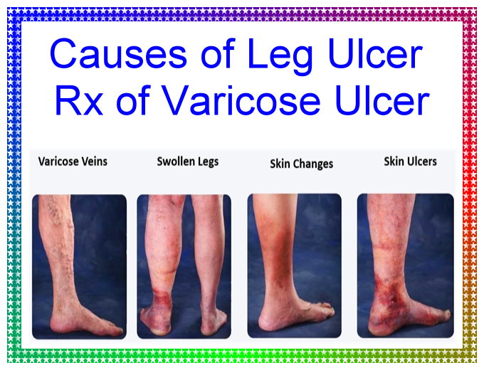 Causes of leg ulcer Rx of varicose ulcer