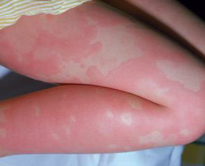 allergie au froid traitement allergie au froid traitement