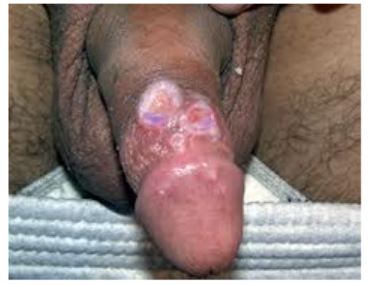 Circumcision Adult Male 15