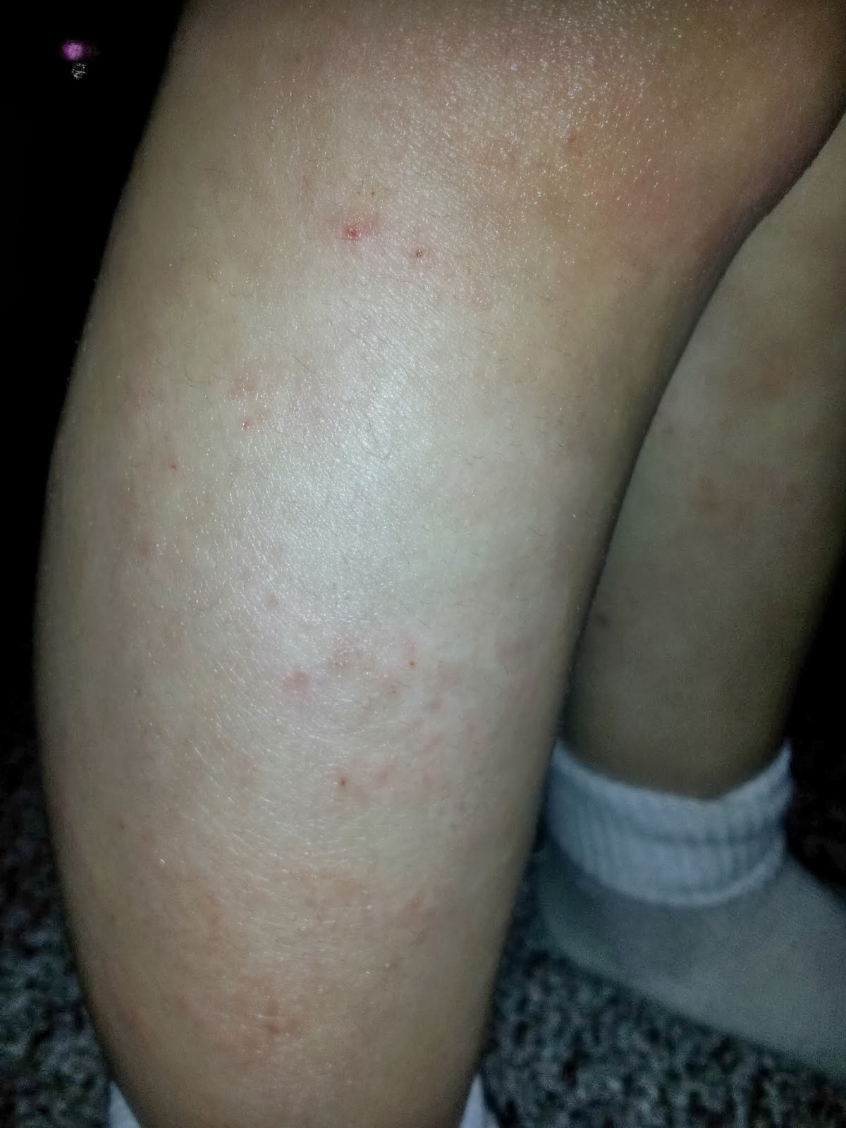 It's a Mom Life Healing a 2 year old's Eczema