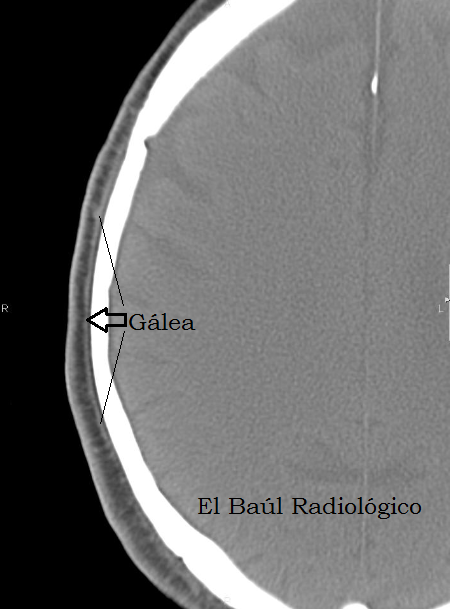 El Ba l Radiol gico 2 HEMATOMA SUBGALEAL HALLAZGOS EN TOMOGRAF A el-ba-l-radiol-gico-2-hematoma-subgaleal-hallazgos-en-tomograf-a
