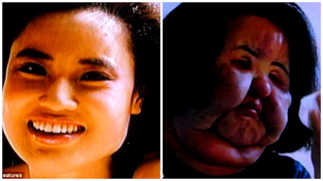 BCN: Photos: Disfigured Woman Injects Cooking Oil Into Her Own Face