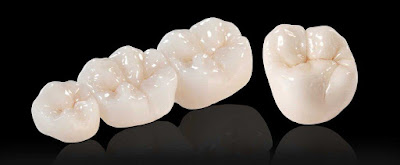 Răng sứ Zirconia có tốt không?