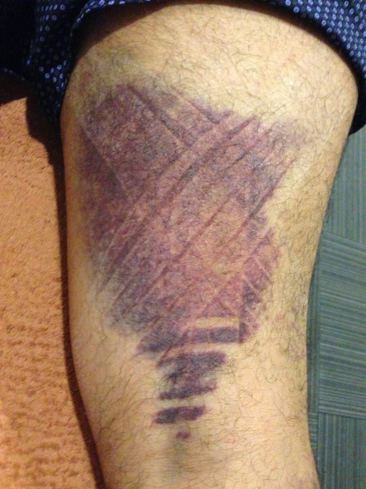 Running Solutions Hamstring/ Calf Pain? Treat Your Back