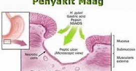 Mengulas Pengertian, gejala, dan cara mengatasi penyakit maag secara