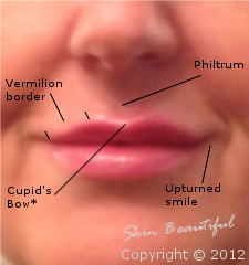 Lip enhancement after treatment