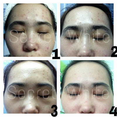 Siêu phẩm trị mụn 300k - Guerir L’acne