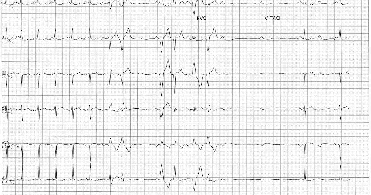 Sinus rhythm with multifocal PVCs and nonconducted P waves