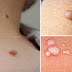 Remove Skin Tags, Corns, Warts Without Scarring, Bleeding Or Pain