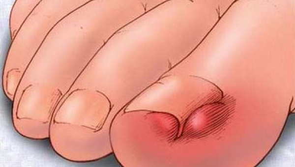 Νύχι που μπαίνει στο δέρμα: Τι μπορείτε να κάνετε στο σπίτι  