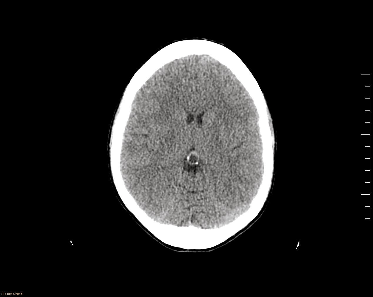 El Blog de Isa y Juan: Cefalea y quiste de la glándula pineal