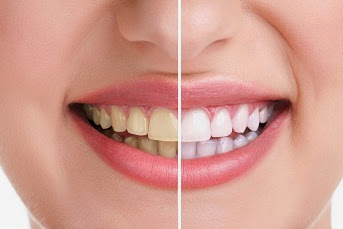 10 Cara Memutihkan Gigi Secara Alami