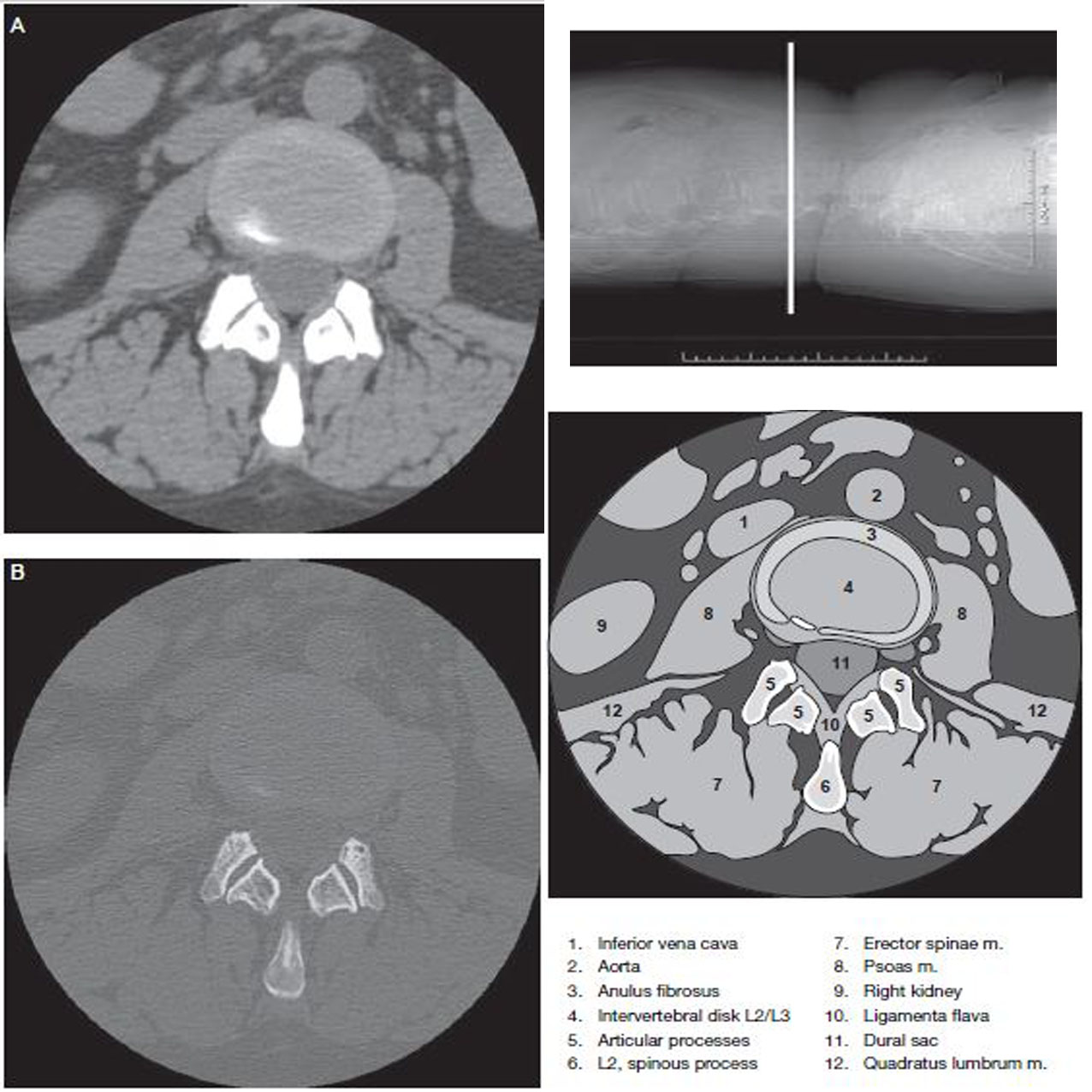Lumbar Spine - Ct Scan - RadTechOnDuty