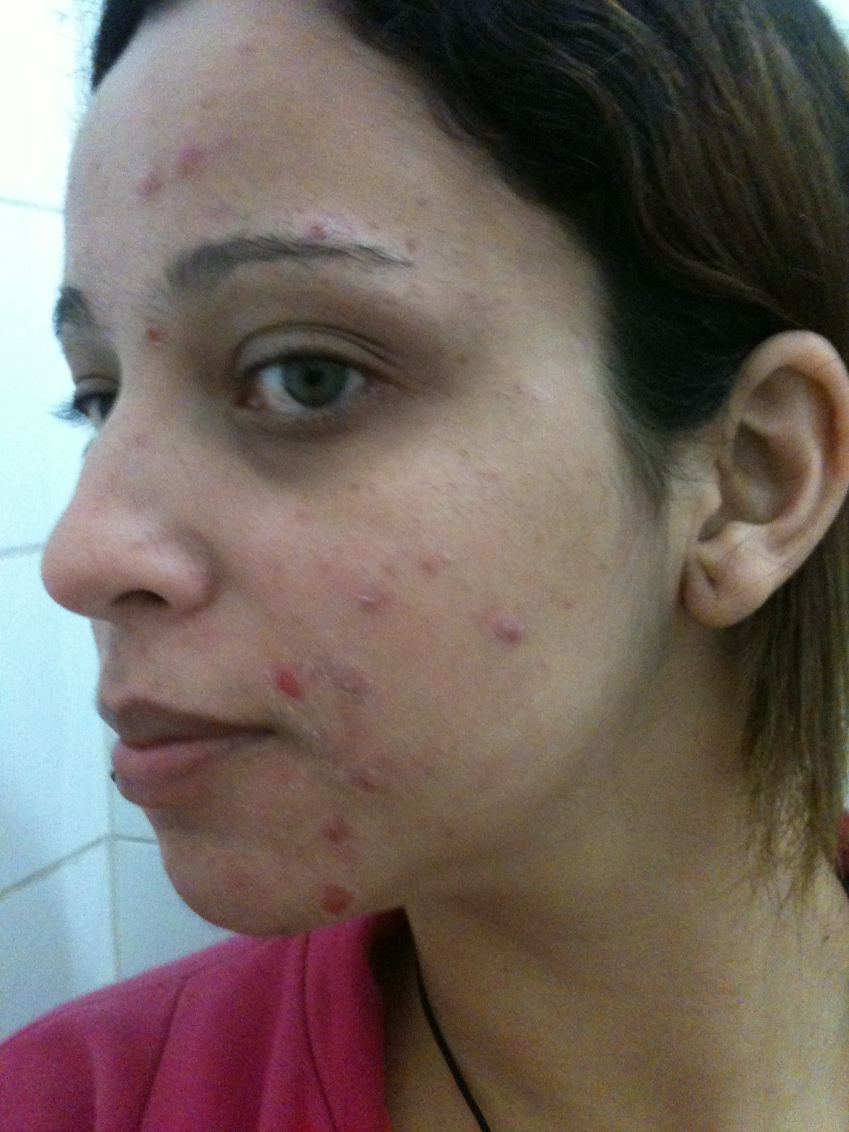 Diário de uma oncinha - Minha história com Roacutan: Abril 2013