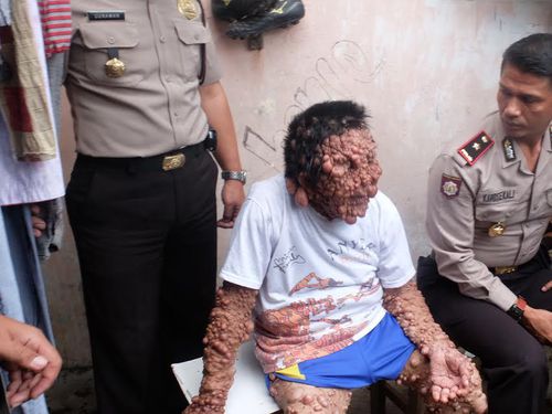 Hati-hati! Tumor Jenis Inilah yang Menutupi Tubuh & Wajah Suadji Hati-hati! Tumor Jenis Inilah yang Menutupi Tubuh & Wajah Suadji